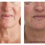 Profhilo Treatment in West Midland