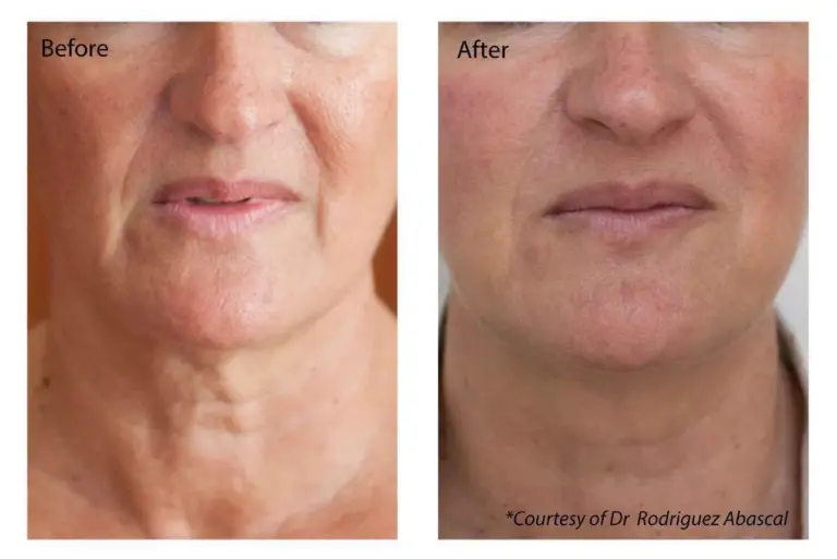 Profhilo at The Medispa: Advanced Skin Booster for Natural, Youthful Radiance Profhilo at The Medispa: Advanced Skin Booster for Natural, Youthful Radiance