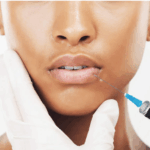 Lip Fillers in Telford