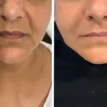 Dermal Fillers in Telford