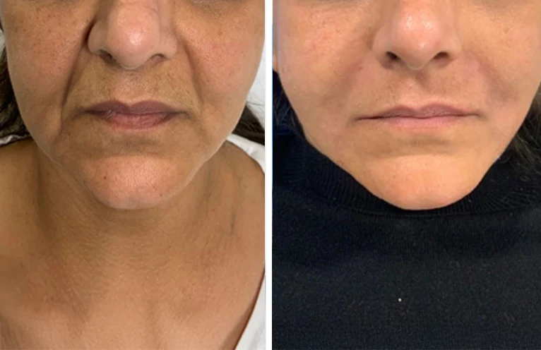Dermal Fillers in Telford