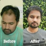 Can PRP Slow Down Ongoing Hair Fall? What You Should Know Before Starting the Treatment