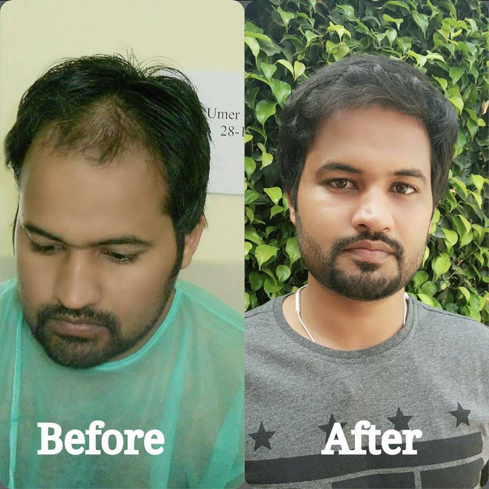 Can PRP Slow Down Ongoing Hair Fall? What You Should Know Before Starting the Treatment