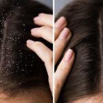 How to Stop Dandruff in Winter Naturally