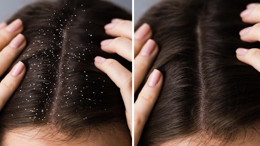 How to Stop Dandruff in Winter Naturally
