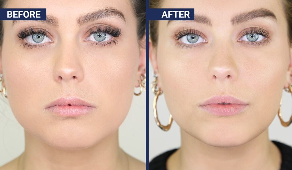 Can Botox Slim the Jawline? Before and After Photos