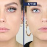 Can Botox Slim the Jawline? Before and After Photos