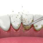 Top 7 Reasons Why Plaque and Tartar Form and How to Prevent Them! Top 7 Reasons Why Plaque and Tartar Form and How to Prevent Them!