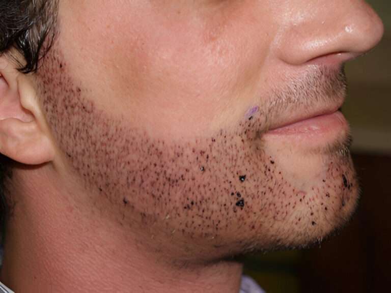 Why Beard Hair Transplant in Islamabad Is Gaining Popularity