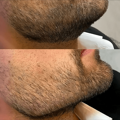 Beard hair transplant in dubai: What to Expect During Surgery