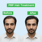Hair Transplant Lahore – FUE Method for Natural Results Hair Transplant Lahore – FUE Method for Natural Results