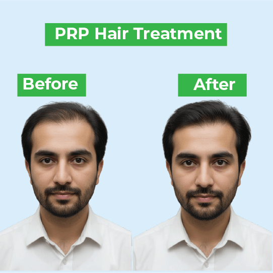 Hair Transplant Lahore – FUE Method for Natural Results