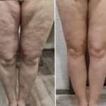 Fat Melting Injection in Dubai: Contouring the Knees and Ankles