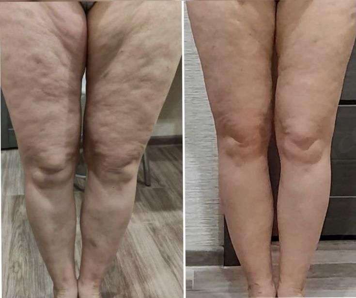 Fat Melting Injection in Dubai: Contouring the Knees and Ankles Fat Melting Injection in Dubai: Contouring the Knees and Ankles