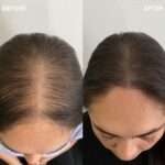 PRP Hair Treatment in Dubai for Natural Hair Regrowth