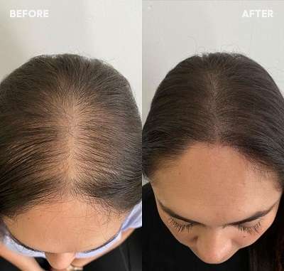 PRP Hair Treatment in Dubai for Natural Hair Regrowth PRP Hair Treatment in Dubai for Natural Hair Regrowth