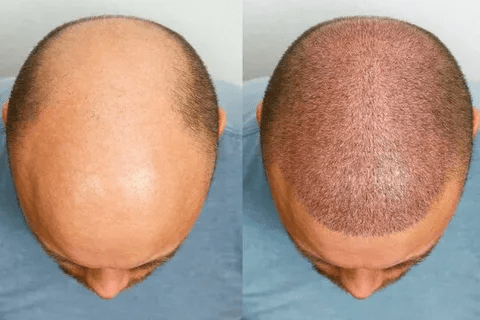 Hair Transplant in Dubai: Advanced FUE and DHI Techniques