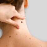 Mole removal in Dubai: Expert Techniques for Clearer Skin Mole removal in Dubai: Expert Techniques for Clearer Skin