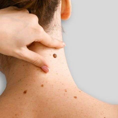 Mole removal in Dubai: Expert Techniques for Clearer Skin
