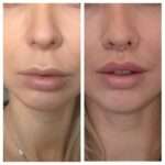 Bullhorn Lip Lift in Dubai: Natural Results for Every Face