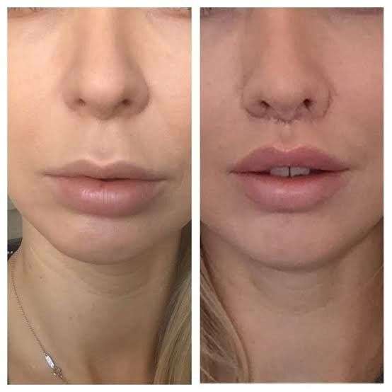 Bullhorn Lip Lift in Dubai: Natural Results for Every Face Bullhorn Lip Lift in Dubai: Natural Results for Every Face