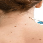 Professional Mole Removal in Dubai: A Patient Guide