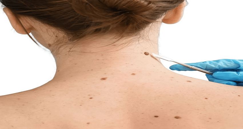 Professional Mole Removal in Dubai: A Patient Guide Professional Mole Removal in Dubai: A Patient Guide