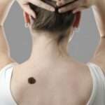 Birthmark Removal in Dubai: Effective Pigment Reduction