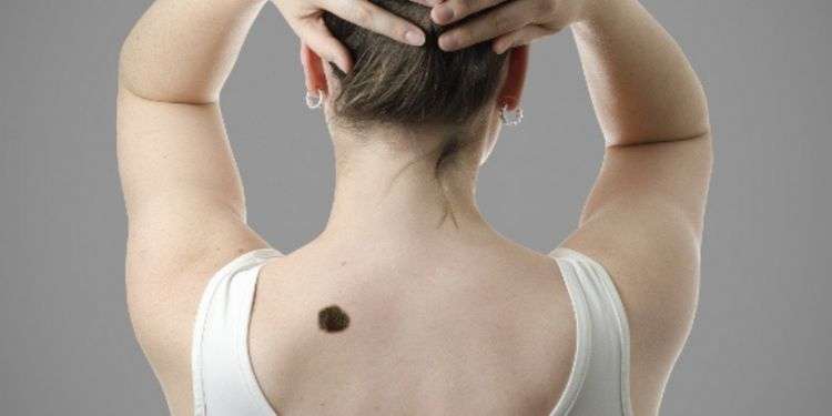 Birthmark Removal in Dubai: Effective Pigment Reduction Birthmark Removal in Dubai: Effective Pigment Reduction