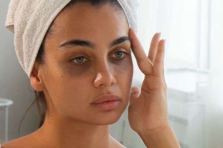 Dark Circles Treatment in Islamabad: Safe Options for Every Skin Type