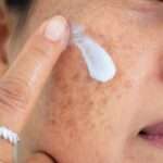 Dark Spot Treatment Options for Healthier and More Even-Looking Skin