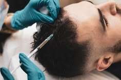 Hair Fillers treatment in Dubai: Non-Surgical Hair Success Hair Fillers treatment in Dubai: Non-Surgical Hair Success