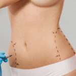 Liposuction in Islamabad: Why More Pakistanis Are Choosing This Procedure Liposuction in Islamabad: Why More Pakistanis Are Choosing This Procedure