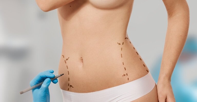Liposuction in Islamabad: Why More Pakistanis Are Choosing This Procedure Liposuction in Islamabad: Why More Pakistanis Are Choosing This Procedure