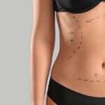Liposuction Surgery in Islamabad: Step-by-Step Procedure Explained