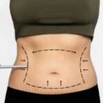 Liposuction in Islamabad: The Secret to Long-Lasting Body Contouring Results