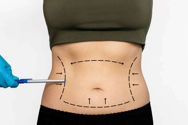 Liposuction in Islamabad: The Secret to Long-Lasting Body Contouring Results