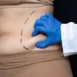 Liposuction Surgery in Islamabad: Exploring Advanced Fat Removal Solutions