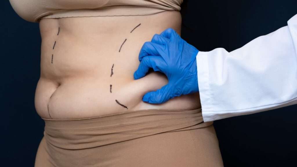 Liposuction Surgery in Islamabad: Exploring Advanced Fat Removal Solutions