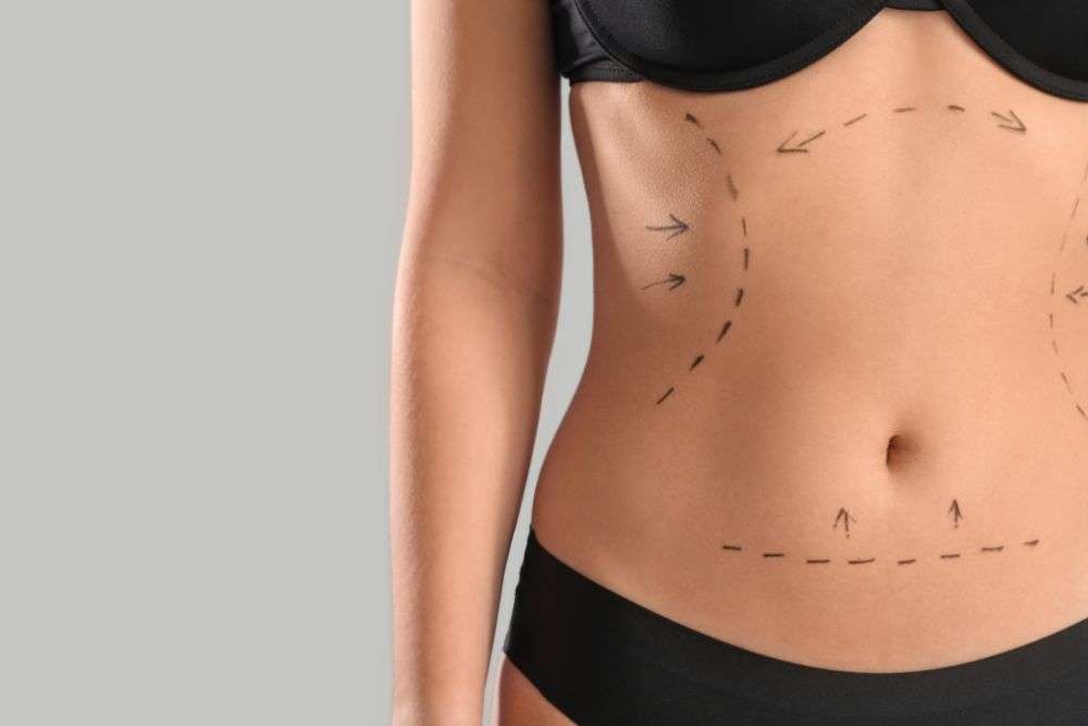 Liposuction Surgery in Islamabad: Step-by-Step Procedure Explained Liposuction Surgery in Islamabad: Step-by-Step Procedure Explained