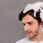 Hair Transplant in Sharjah: Modern Techniques for Hair