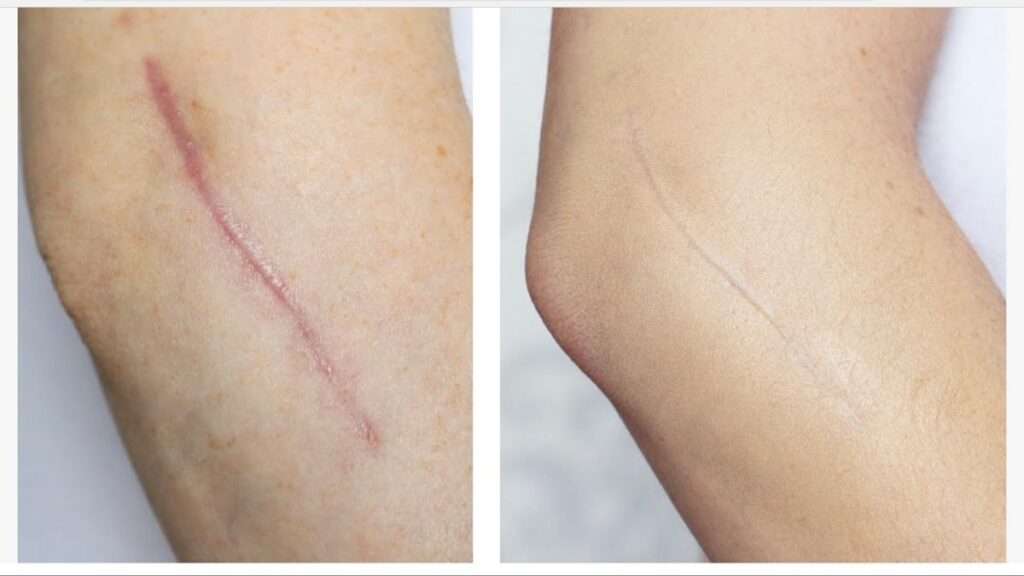 Post Surgical Scar Treatment in Dubai: Clear Results