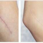 Post Surgical Scar Treatment in Dubai: Clear Results