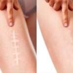 Laser Scar Removal in Dubai: Advanced Repair