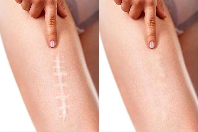 Laser Scar Removal in Dubai: Advanced Repair