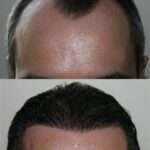 Hair Transplant Dubai: Clinical Approaches Explained Hair Transplant Dubai: Clinical Approaches Explained