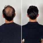 Scarless Hair Transplant in Dubai: Why It Is the Top Choice