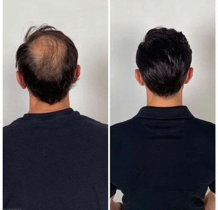 Scarless Hair Transplant in Dubai: Why It Is the Top Choice Scarless Hair Transplant in Dubai: Why It Is the Top Choice