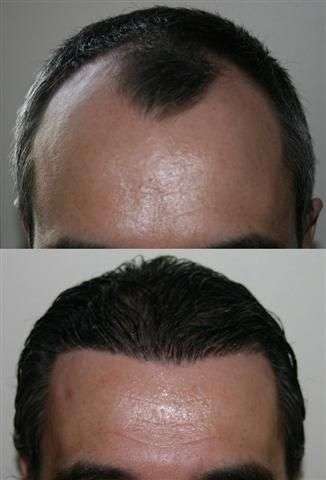 Hair Transplant Dubai: Clinical Approaches Explained Hair Transplant Dubai: Clinical Approaches Explained