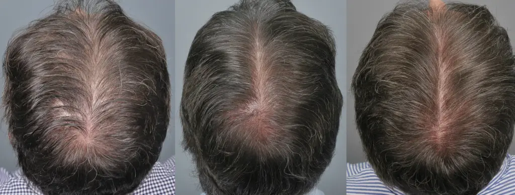 1 Dirham Hair Transplant in Dubai: Facts for Patients